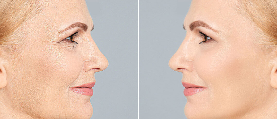 Before & After